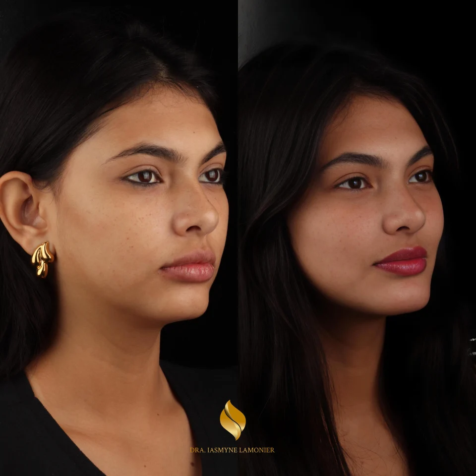 Iasmyne antes e depois